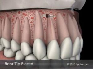 root end surgery