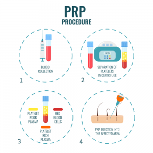  اثناء حقن البلازما للوجه او بی ار بی (PRP) 