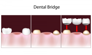 جسر الأسنان