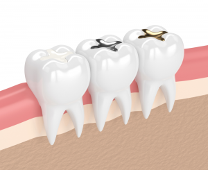 glass ionomer filling cost
