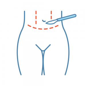Abdominal etching