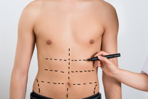 Abdominal etching