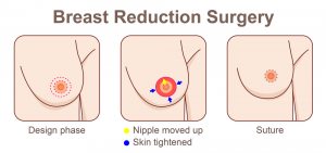 Breast Reduction