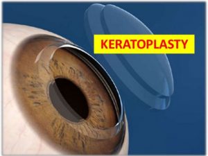 Conductive keratopalsty