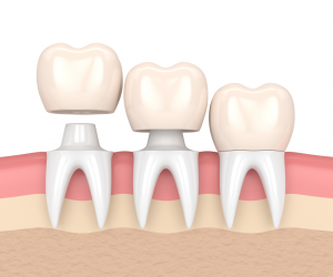 Dental Crown
