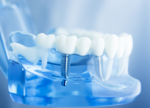 Dental Implant