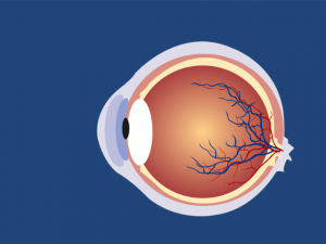 Diabetic retinopathy