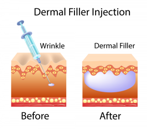 Fillers