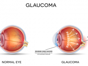 Glaucoma