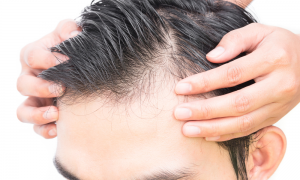 Hairline Lowering