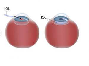 IOL