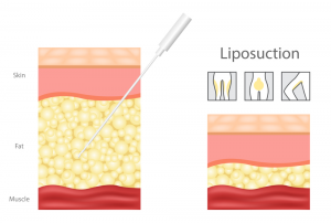 Liposuction