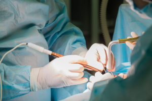 Liposuction