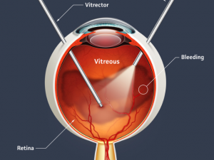 Vitrectomy