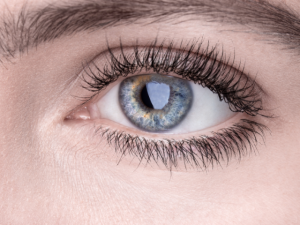 cataract