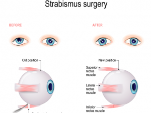 strabismus