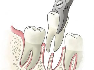 Tooth Extractions