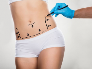 abdominoplasty