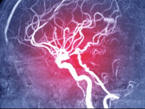 angiography