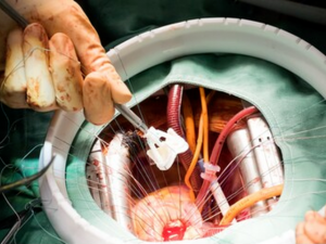 aortic valve replacement