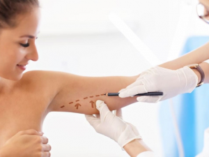 brachioplasty