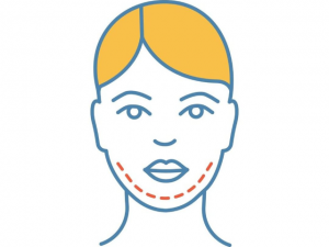 chin reduction