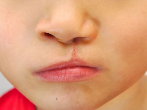 cleft repair