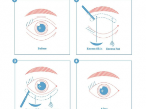 eylide surgery