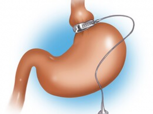 gastric band