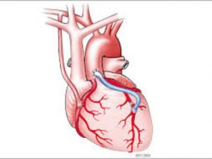 heart byepass