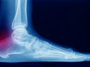Achilles Tendon Surgery