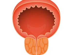 Acute Prostatitis treatment