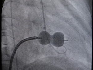 Balloon valvuloplasty