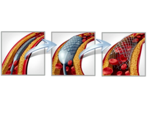 Coronary Angioplasty