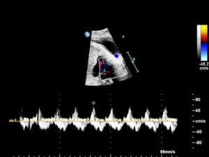 Doppler echocardiography-