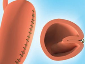 Gastric-plication