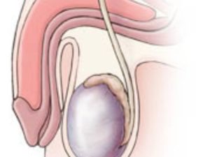 Hydrocelectomy