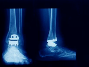 ankle replacement