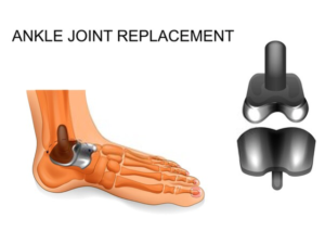 ankle replacement
