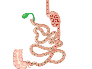 duodenal switch