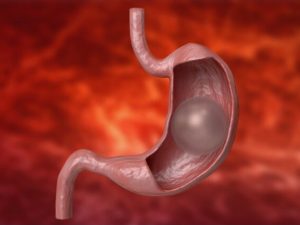 gastric balloon