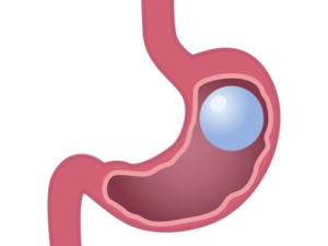 gastric balloon