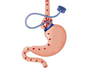gastric band