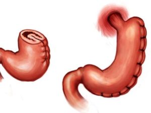 gastric plication