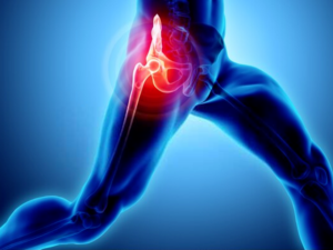 hip replacement