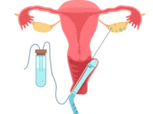 ivf