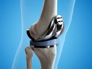 knee replacement