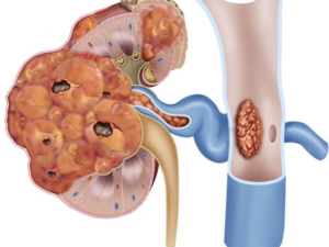nephrectomy