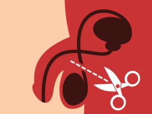 vasectomy