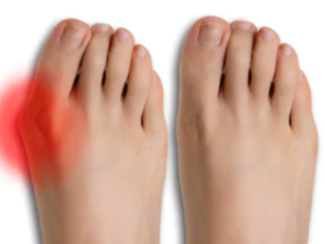 Bunion Surgery